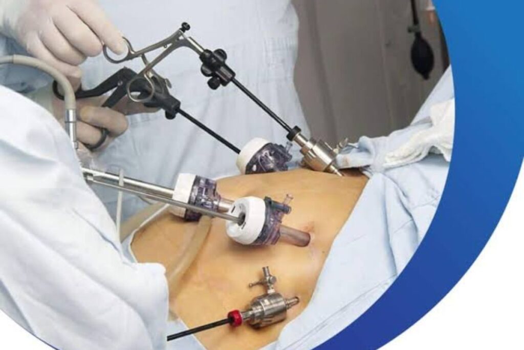 Laparoscopic Hysterectomy in Raipur